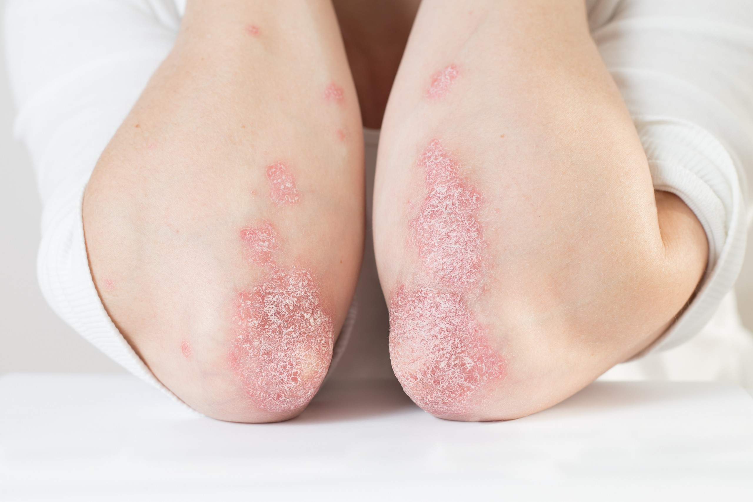 Acute psoriasis on the elbows is an autoimmune incurable dermatological skin disease. Large red, inflamed, flaky rash on the knees. Joints affected by psoriatic arthritis