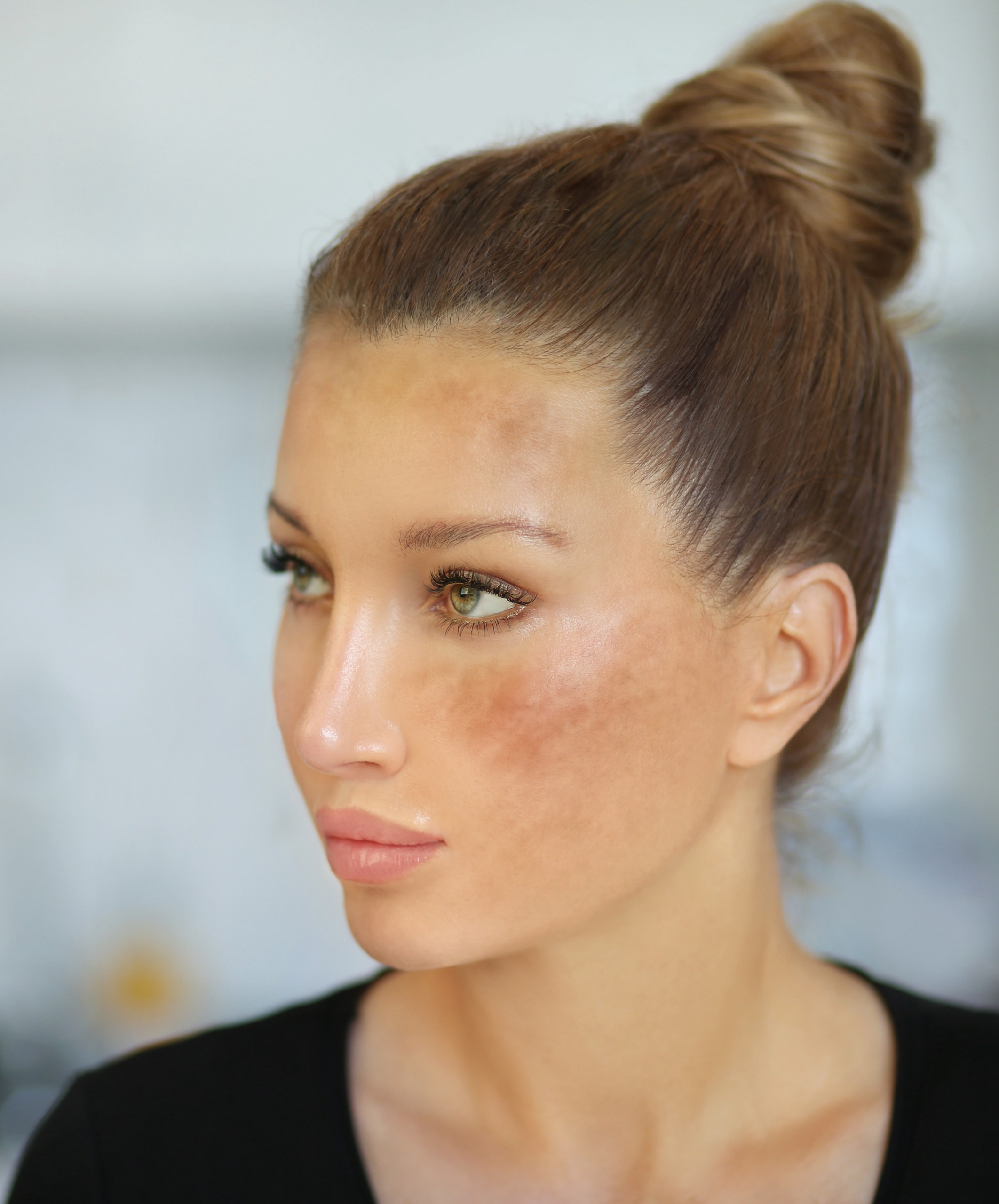 SKIN HYPERPIGMENTATION