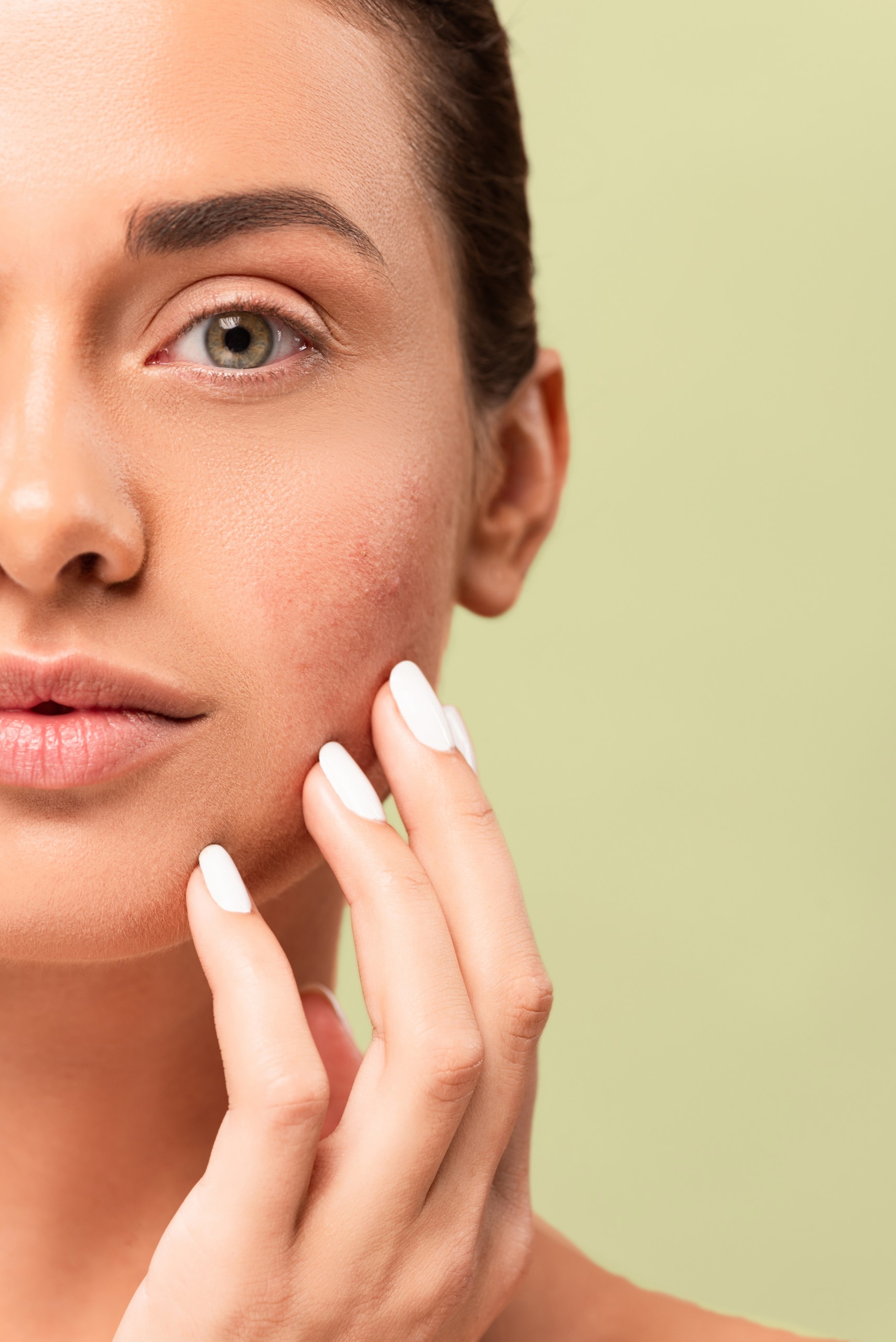 cropped view of girl touching face with problem skin and looking OILY SKIN WITH ACNE PRONE TENDENCY